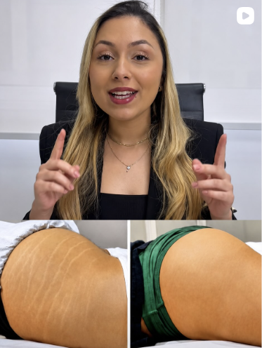 Raianne Darla apresenta um resultado de tratamento de estrias